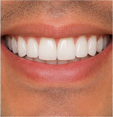 Resultado ilustrativo de reabilitação do sorriso