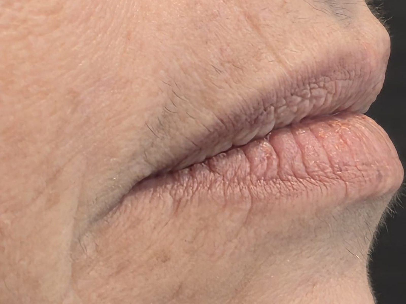Imagem ilustrativa de harmonização labial antes