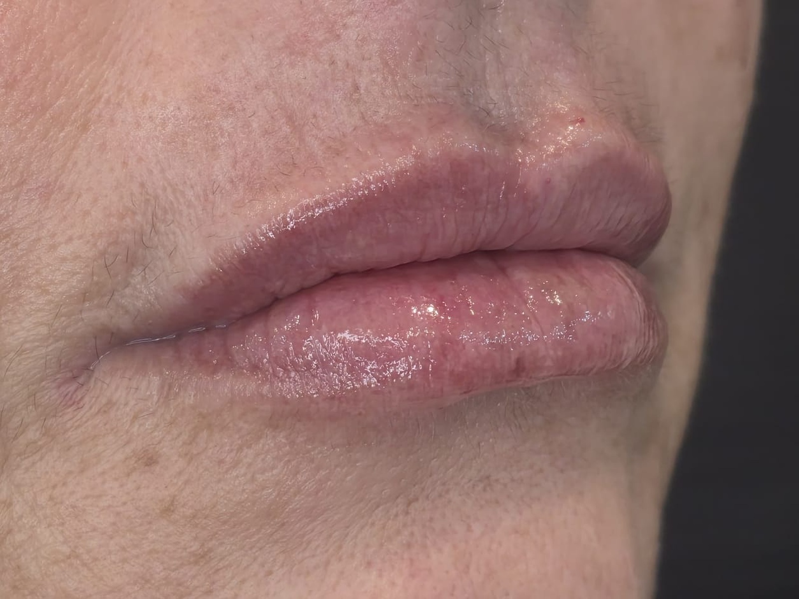 Imagem ilustrativa de harmonização labial depois